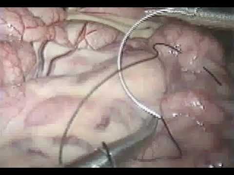 Algorithms for Surgical Skills Assessment  - Blue Dragon - Novice Surgeon (R1) - Suturing