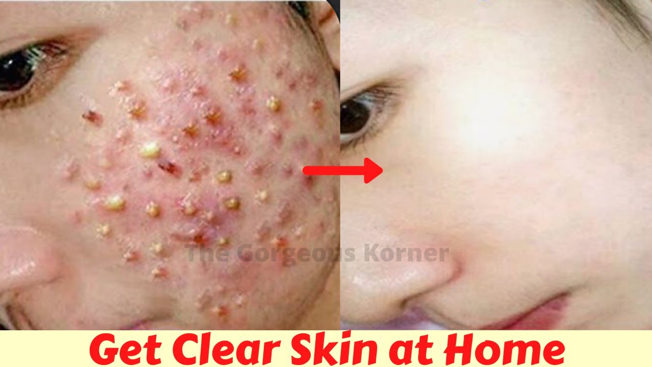 Remove Pimples Dark Spots Acne Scars Pigmentation Easily At Home remove-pimples-dark-spots-acne-scars-pigmentation-easily-at-home