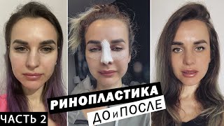 видео: РИНОПЛАСТИКА в Санкт-Петербурге | До и ПОСЛЕ | Реабилитации после ринопластики. Часть 2 картинка: РИНОПЛАСТИКА в Санкт-Петербурге | До и ПОСЛЕ | Реабилитации после ринопластики. Часть 2