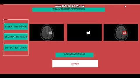 Brain Tumor Detection using Matlab - Image Processing