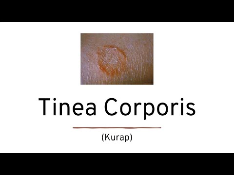 Video: Kurap Tubuh (Tinea Corporis)