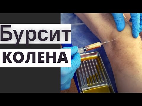 Видео: Проходит ли препателлярный бурсит?