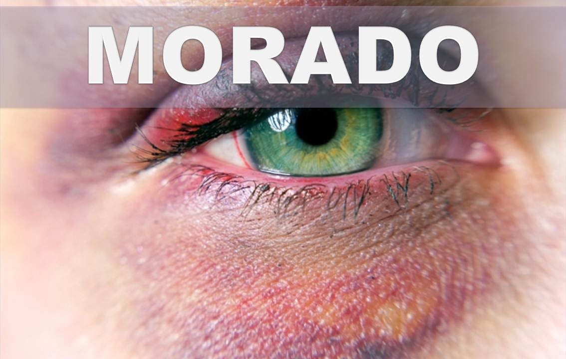 Como Quitar Un Moreton En El Ojo Rapido Consejos Ojos