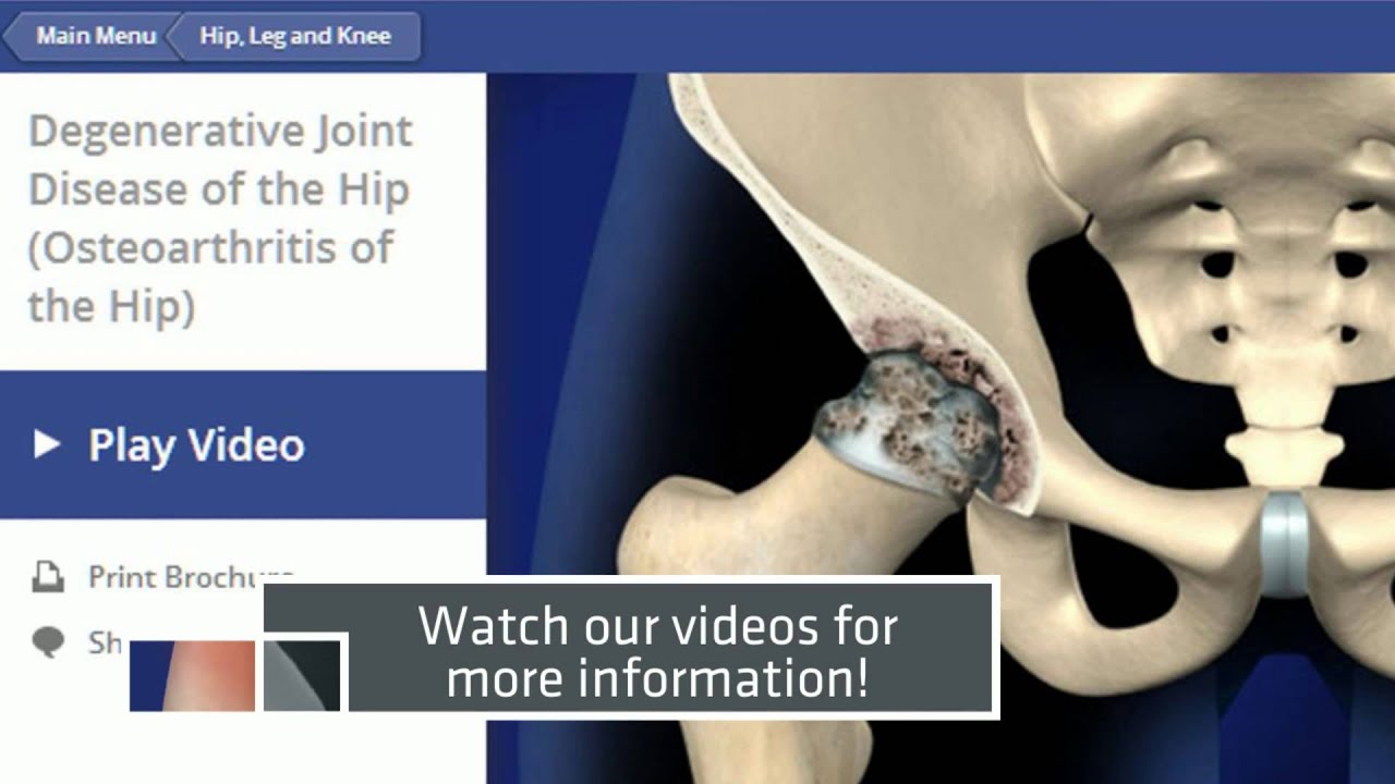 Degenerative Joint Disease Hip Osteoarthritis Tampa Pain Physicians 