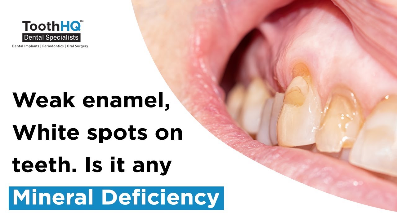 Weak enamel, White spots on teeth? Is it any Mineral Deficiency Dallas