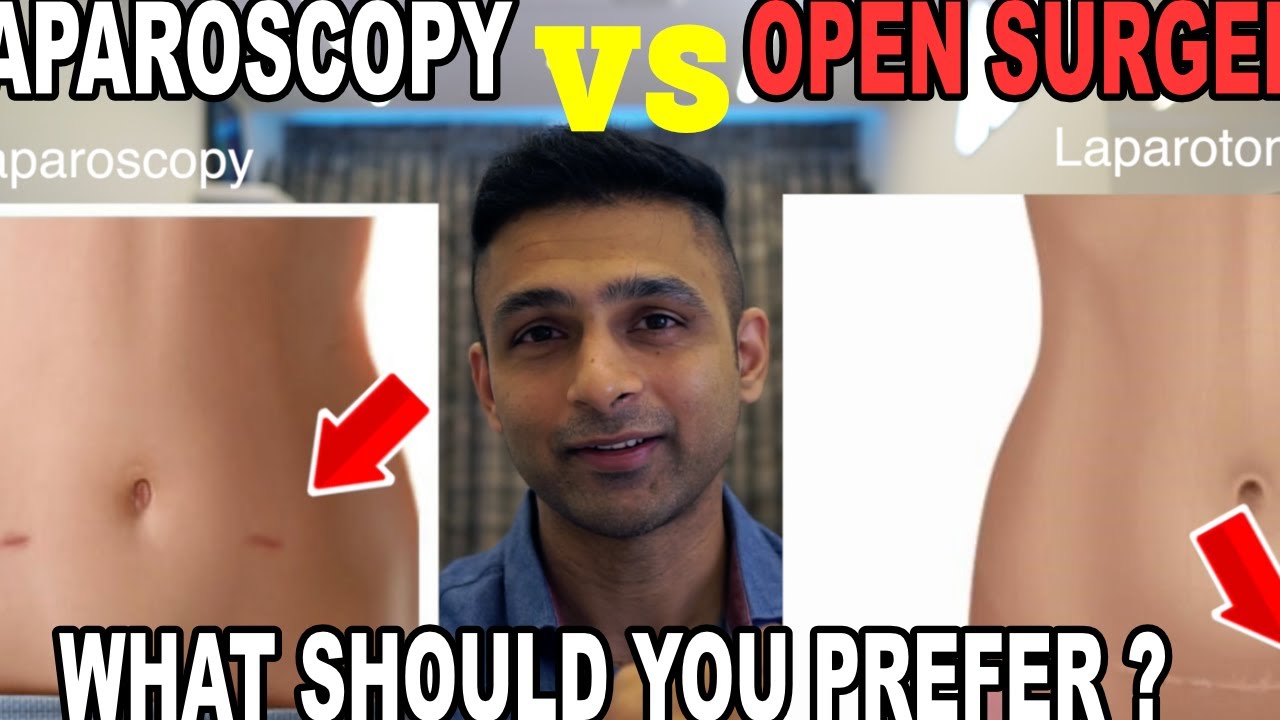Laparoscopy versus open surgery . What should you prefer ? YouTube