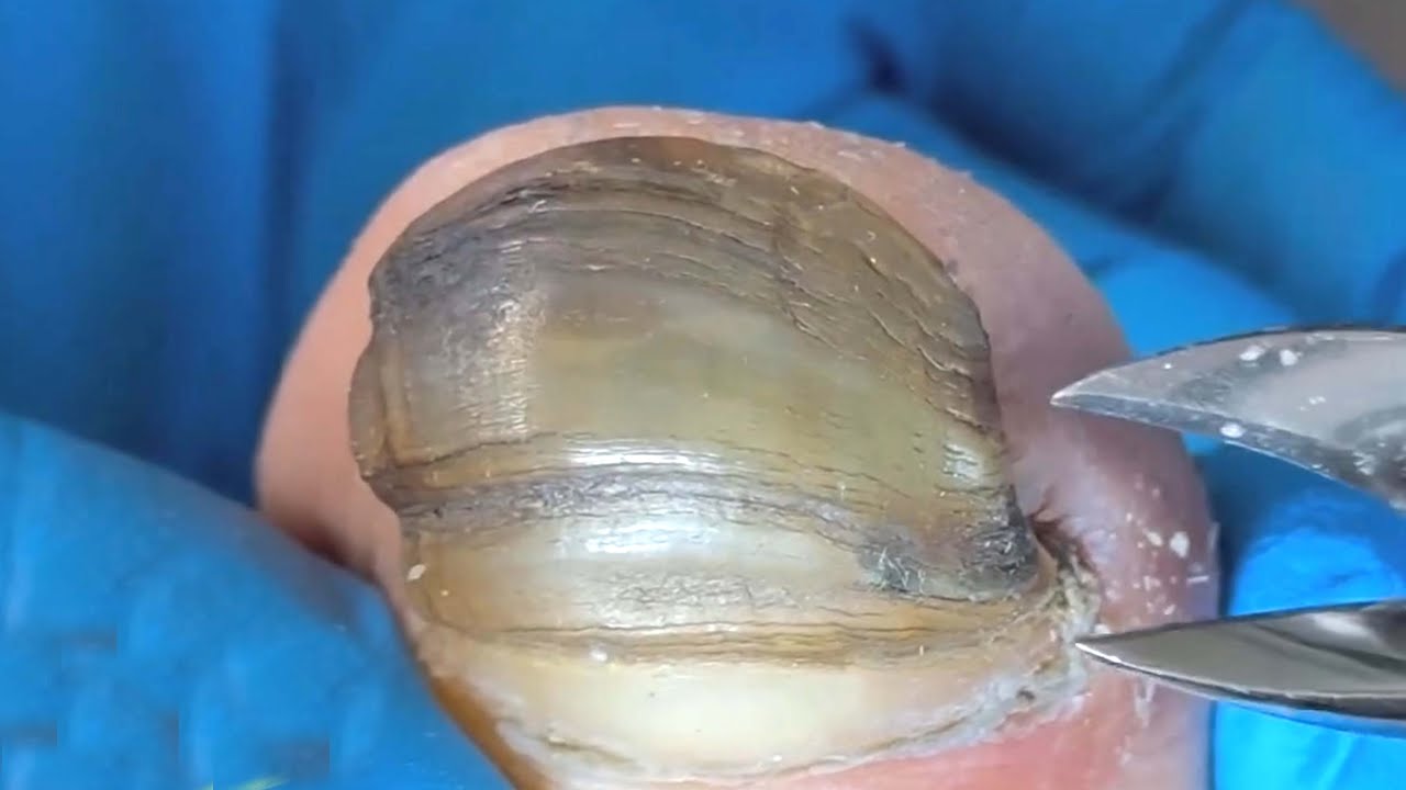 Relaxing Pedicure Tutorial Video 7#asmr #ingrown 【pedicure Wang】