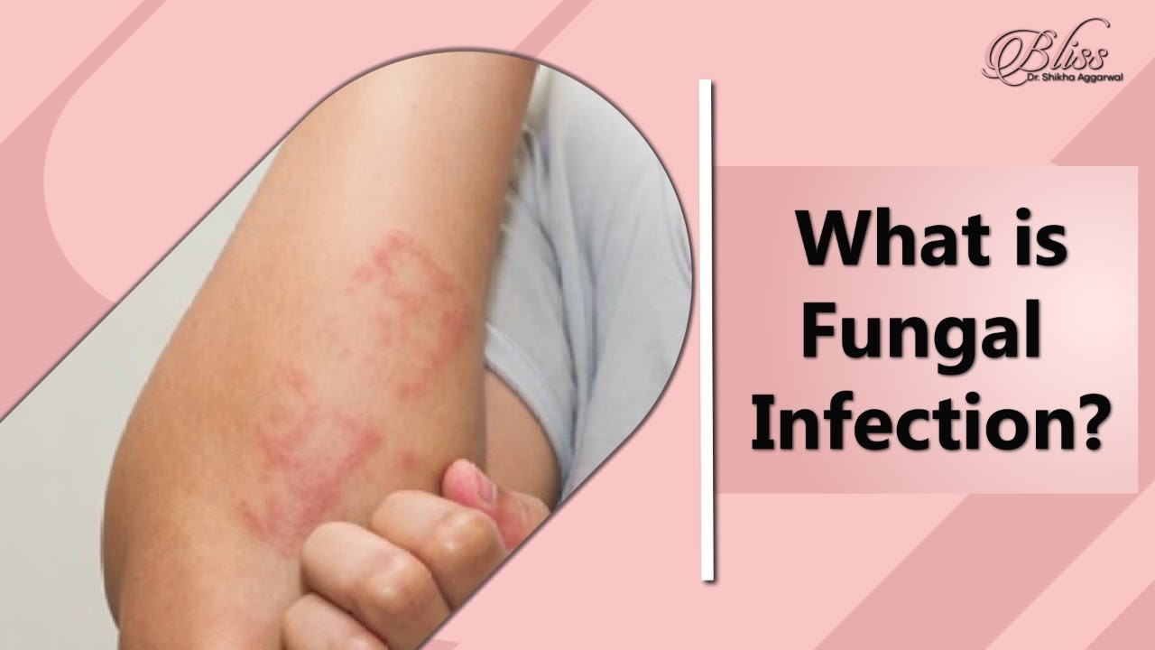 What is Fungal Infection Types of Fungal Infection Fungal Infection