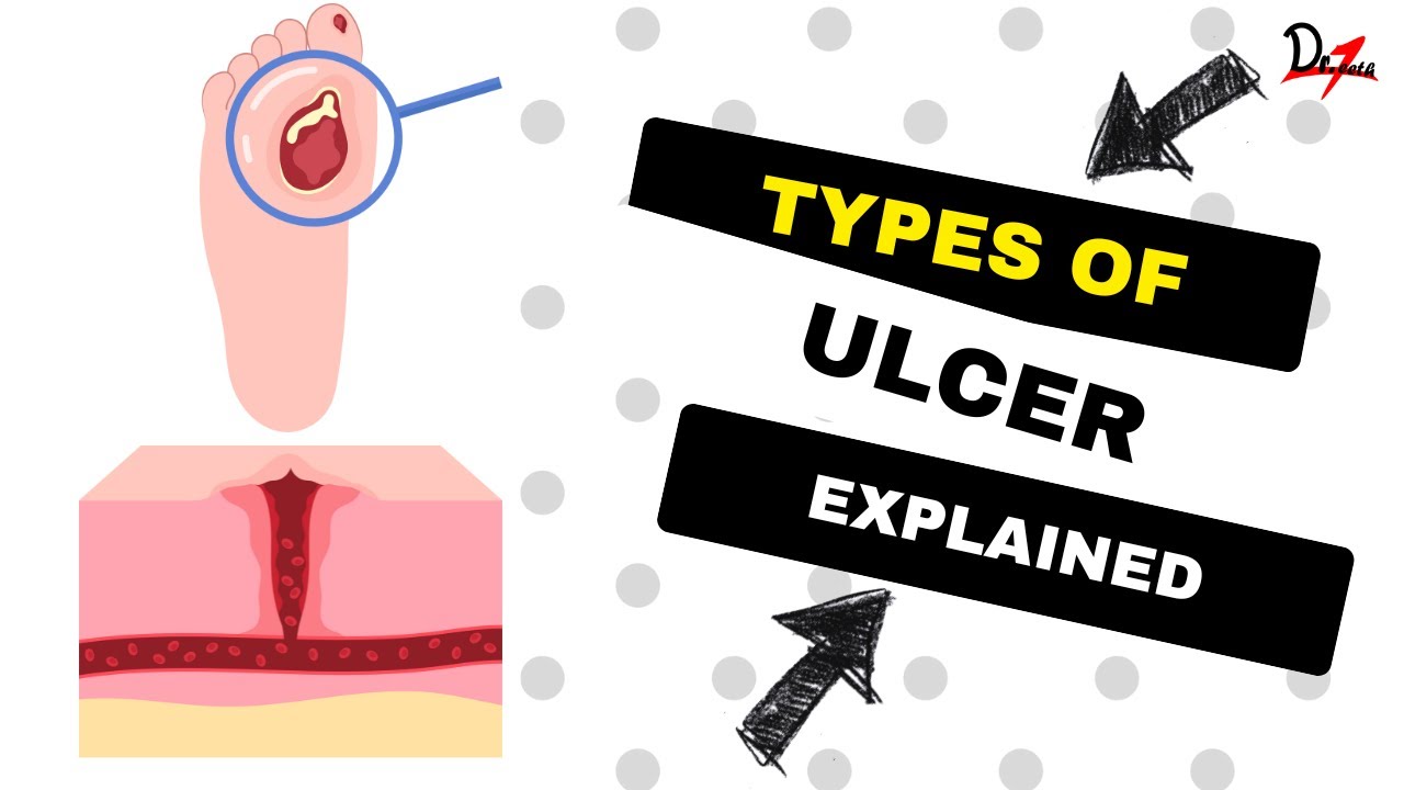 Ulcers Explained Types YouTube