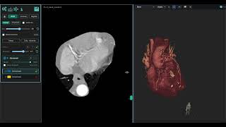 Cardiac CT segmentation in MedSeg in under 3 minutes, no AI