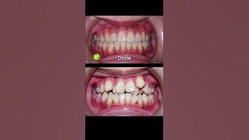 Niềng răng mắc cài khắc phục tình trạng răng khấp khểnh #nhakhoathutrang #shorts #niengrang #braces