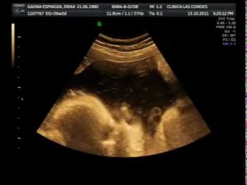 Para que sirve la ecografia doppler obstetrica