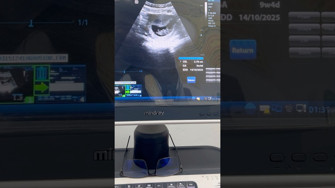 CRL & FHR in 9 weeks pregnancy ultrasound 