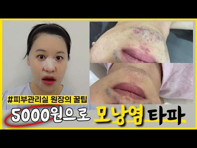 📣모낭염 단 돈 5000원으로 없애는 방법