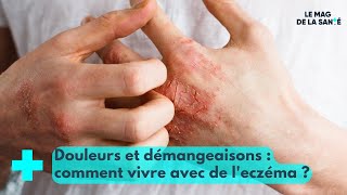 Eczéma : une maladie qui dérange et qui démange - Le Mag de la Santé