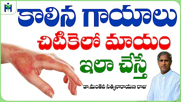 కాలిన గాయాలు చిటికెలో మాయం ఇలా | Skin Burn Tips in Telugu | Dr Manthena Satyanarayana Raju Videos