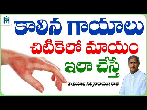 కాలిన గాయాలు చిటికెలో మాయం ఇలా | Skin Burn Tips in Telugu | Dr Manthena Satyanarayana Raju Videos