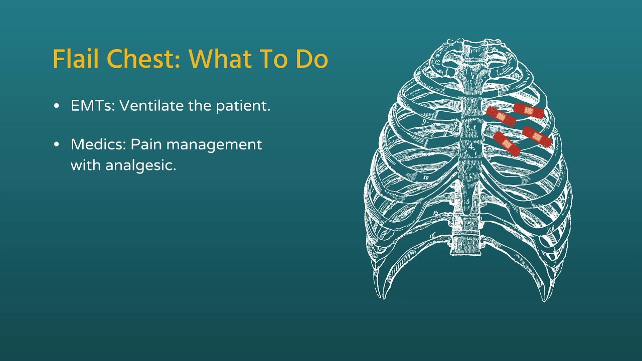 Chest Trauma: Flail Chest