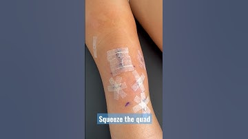 ACL Reconstruction Surgery : Quad strengthening (5 days follow surgery) #shorts