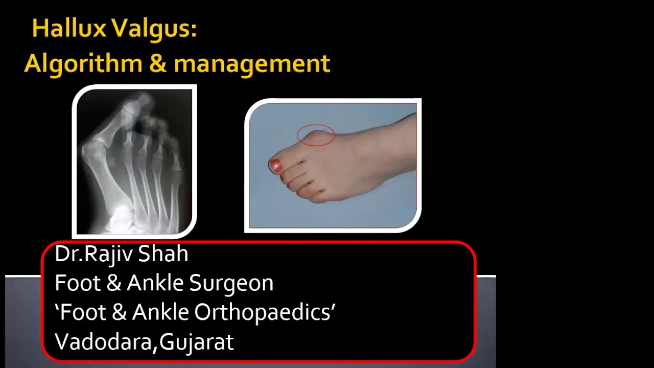 TO PASS DNB MS ORTHOPAEDICS CASE 104 HALLUX VALGUS AND FLAT FOOT to-pass-dnb-ms-orthopaedics-case-104-hallux-valgus-and-flat-foot