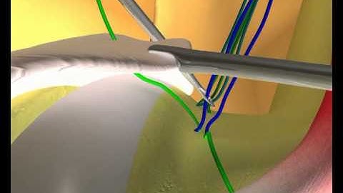Dr. Ashish Babhulkar - Arthroscopic Subscapularis Repair - Cruciate technique