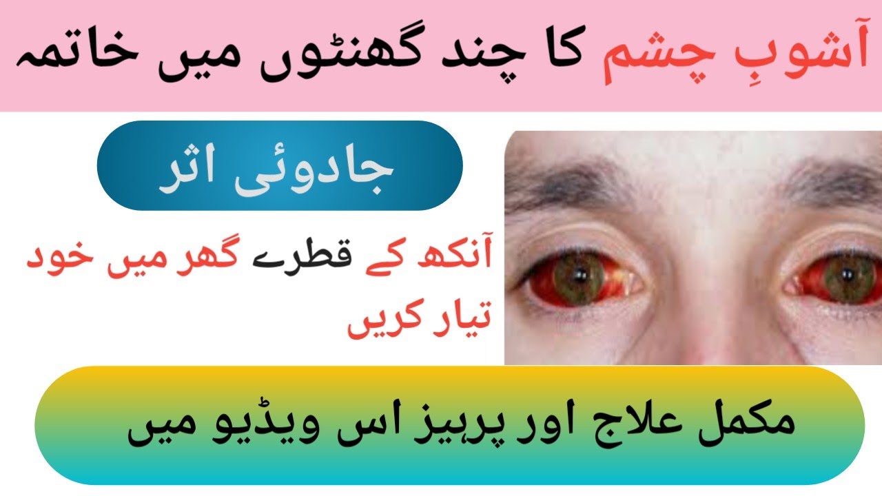 CONJUNCTIVITIS 1/ EYE FLU/ EYE INFECTION/ CURE QUICKLY/DR NASEER AHMED