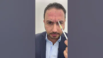 تعليمات حقن البوتوكس ورفع الحاجب 
