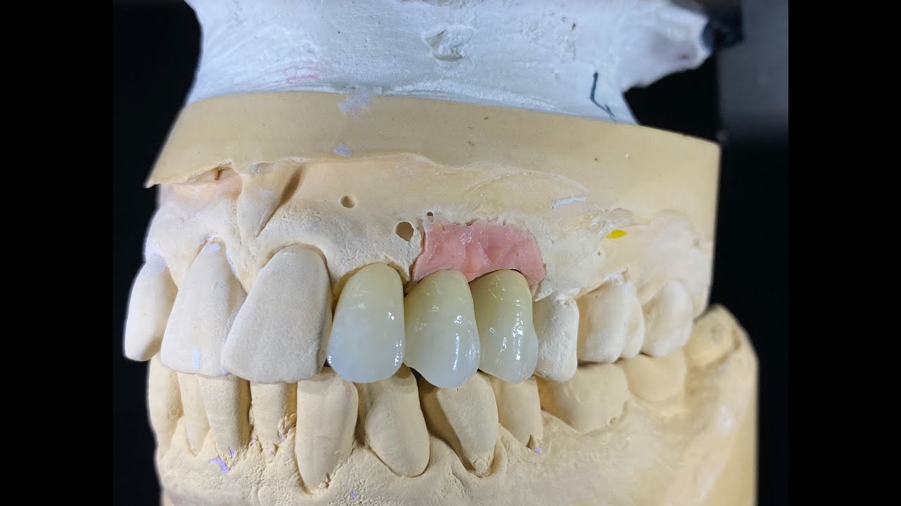 STUDIU DE CAZ : 3 canini pe arcada superioara