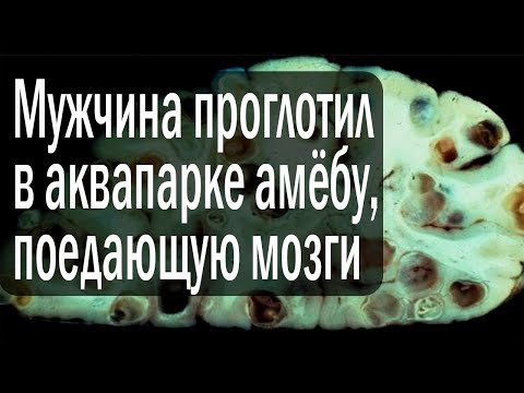 Мужчина проглотил в аквапарке амёбу, поедающую мозги