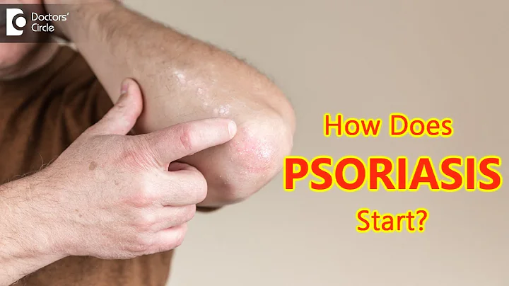 How does psoriasis start? Main Causes & Symptoms - Dr. Chaithanya K S  | Doctors' Circle - DayDayNews