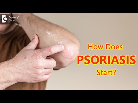 Video: Kur prasideda psoriazė?