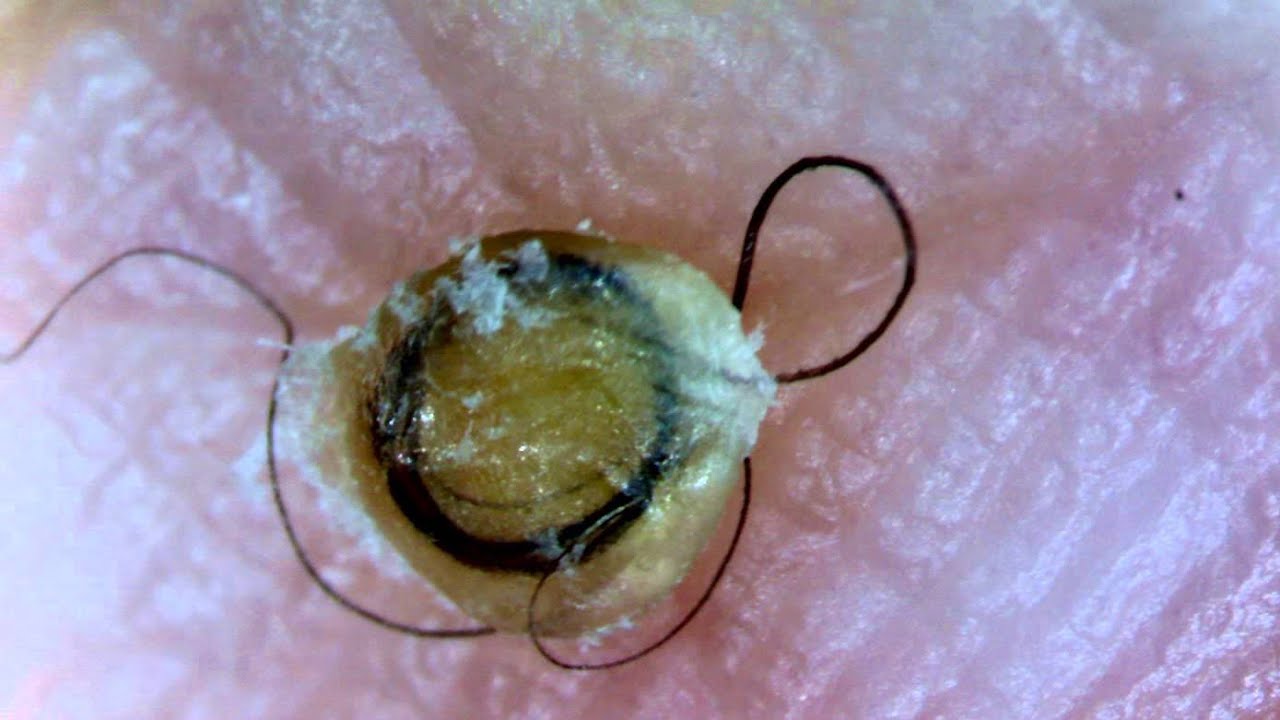 【Pic】Hair in the Blackhead YouTube