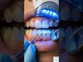Teeth Whitening #dentalcare #toothpainrelief #dentalwellnesstips #oralhygiene #teeth #teethwhitening