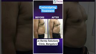 CoolSculpting(Cryolipolysis) Explained|Fat Freezing Treatment Results at Derma solutions, Bangalore