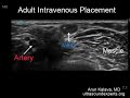 Ultrasound guided vascular access