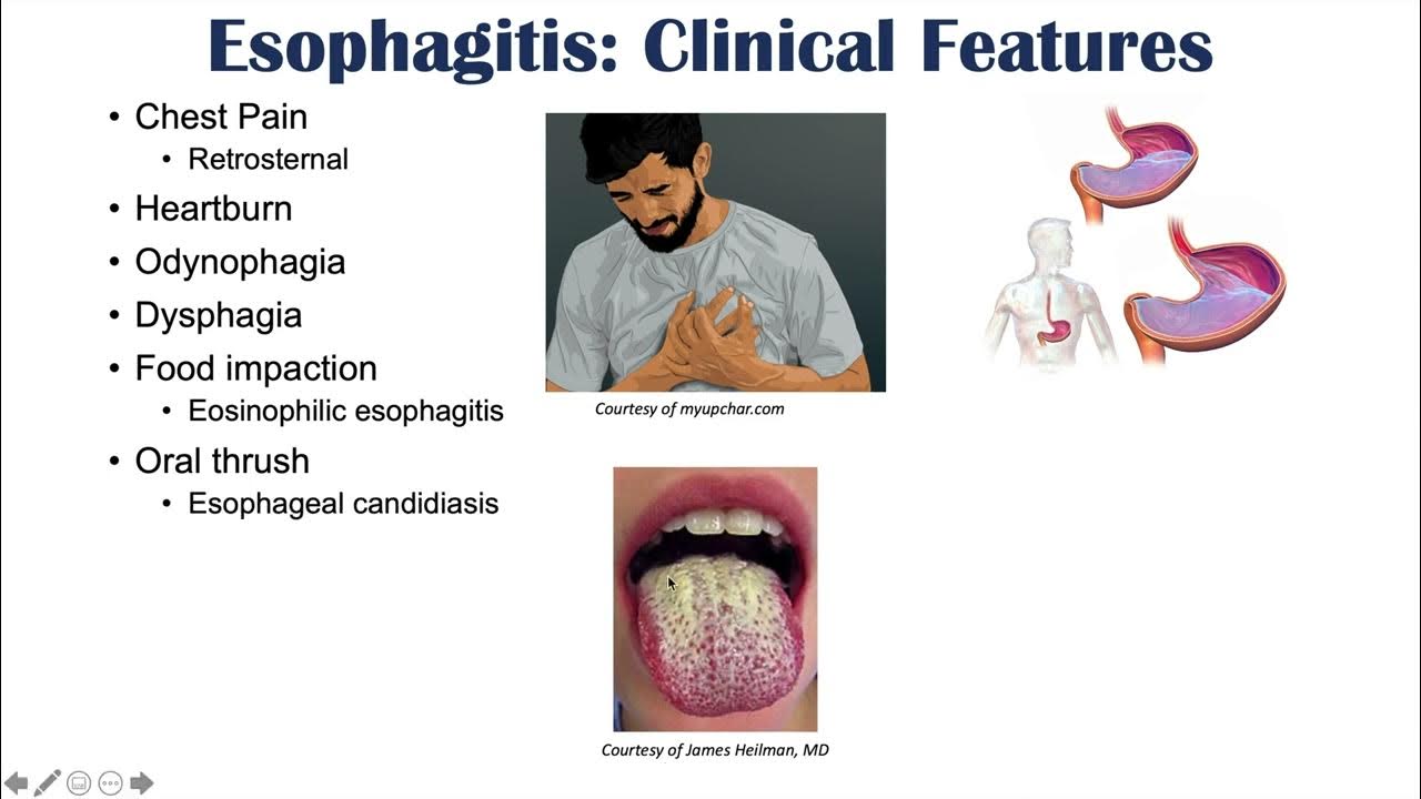 Esophagitis Esophagus Inflammation Causes, Risk Factors, Signs and