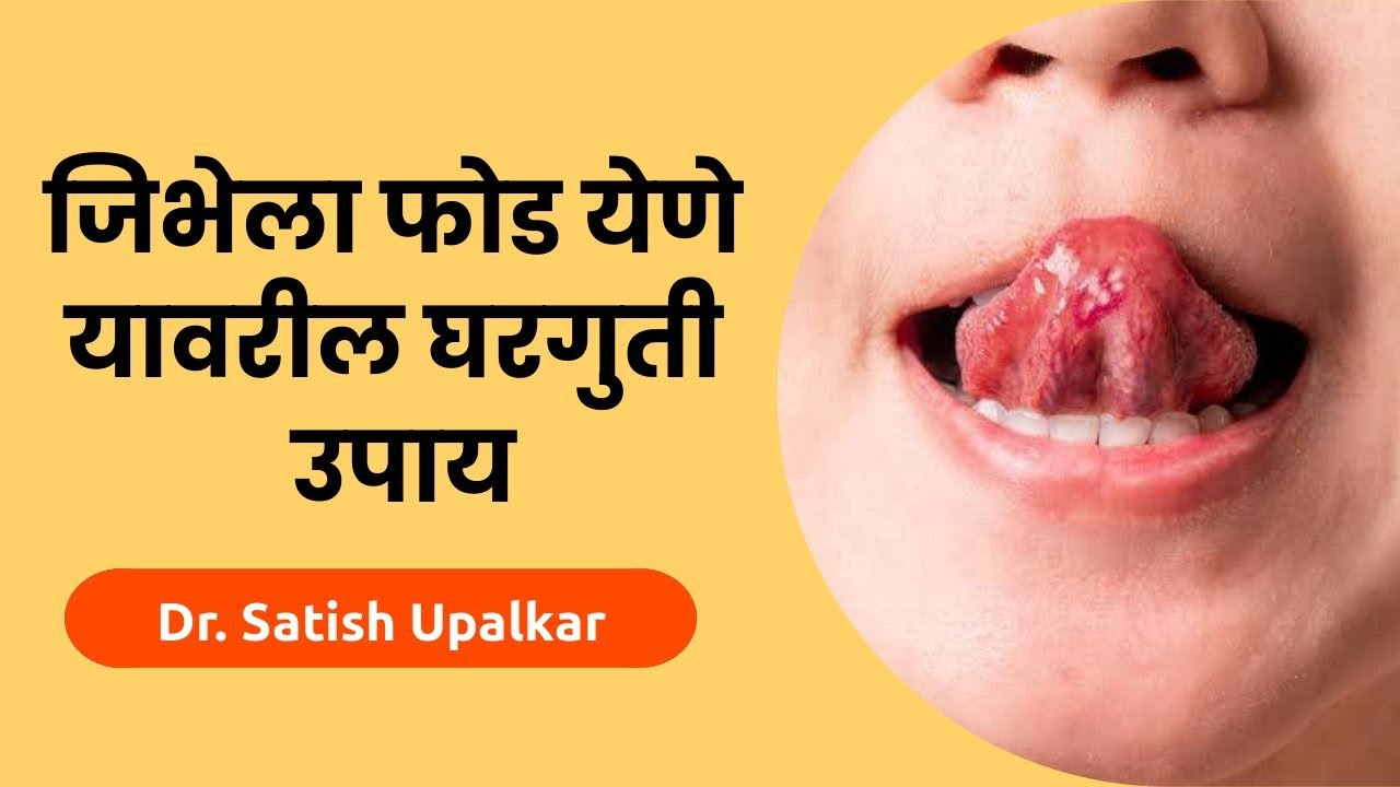 जिभेला फोड येणे यावरील घरगुती उपाय डॉ सतीश उपळकर Jibhela phod yene
