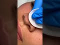 #PimplePixy #AcneClean #SatisfyingExtraction #PimplePopping #skincareasmr