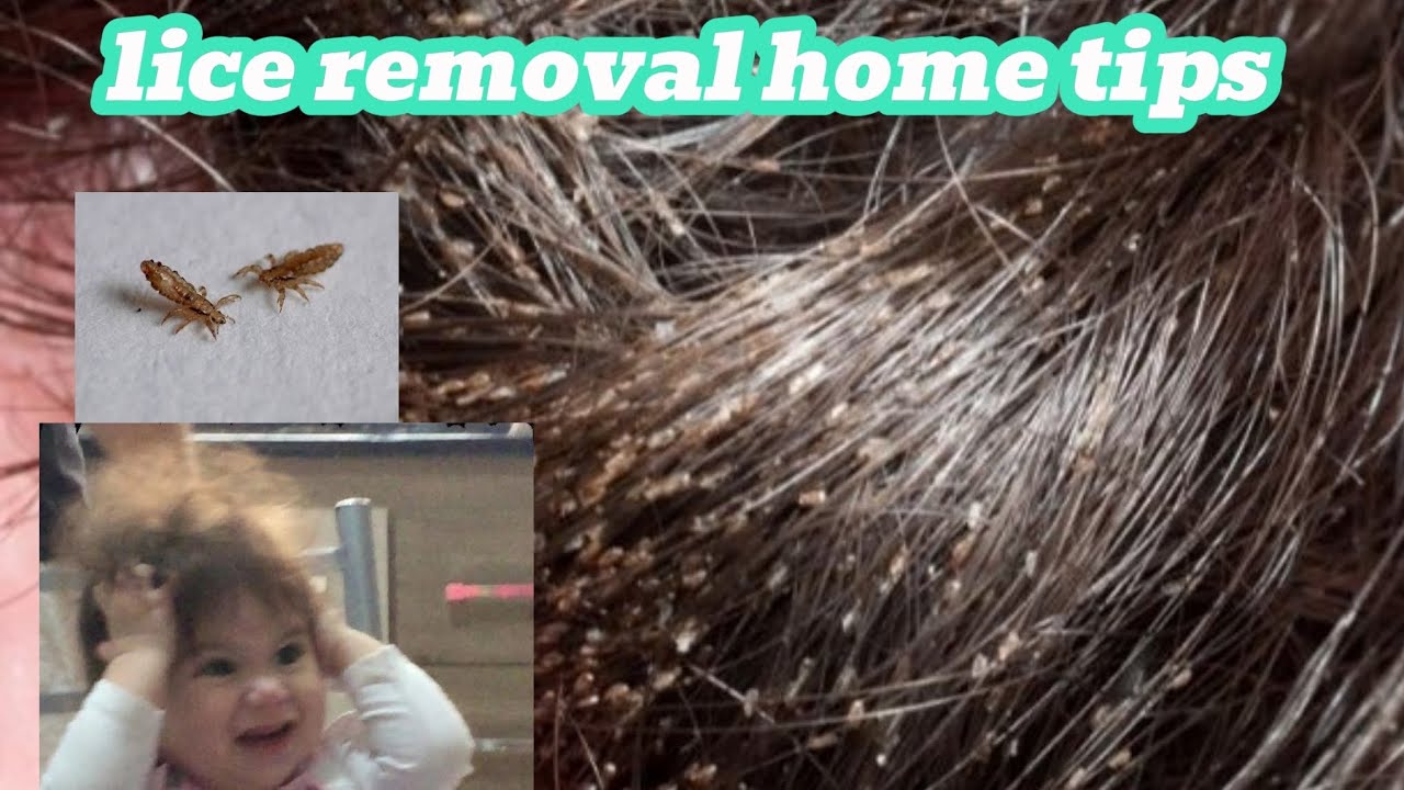 #LiceRemoval