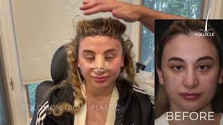 Hairline Lowering Surgery | Hair Transplant Clinic in Toronto,  FUE and FUT hair clinic Profile