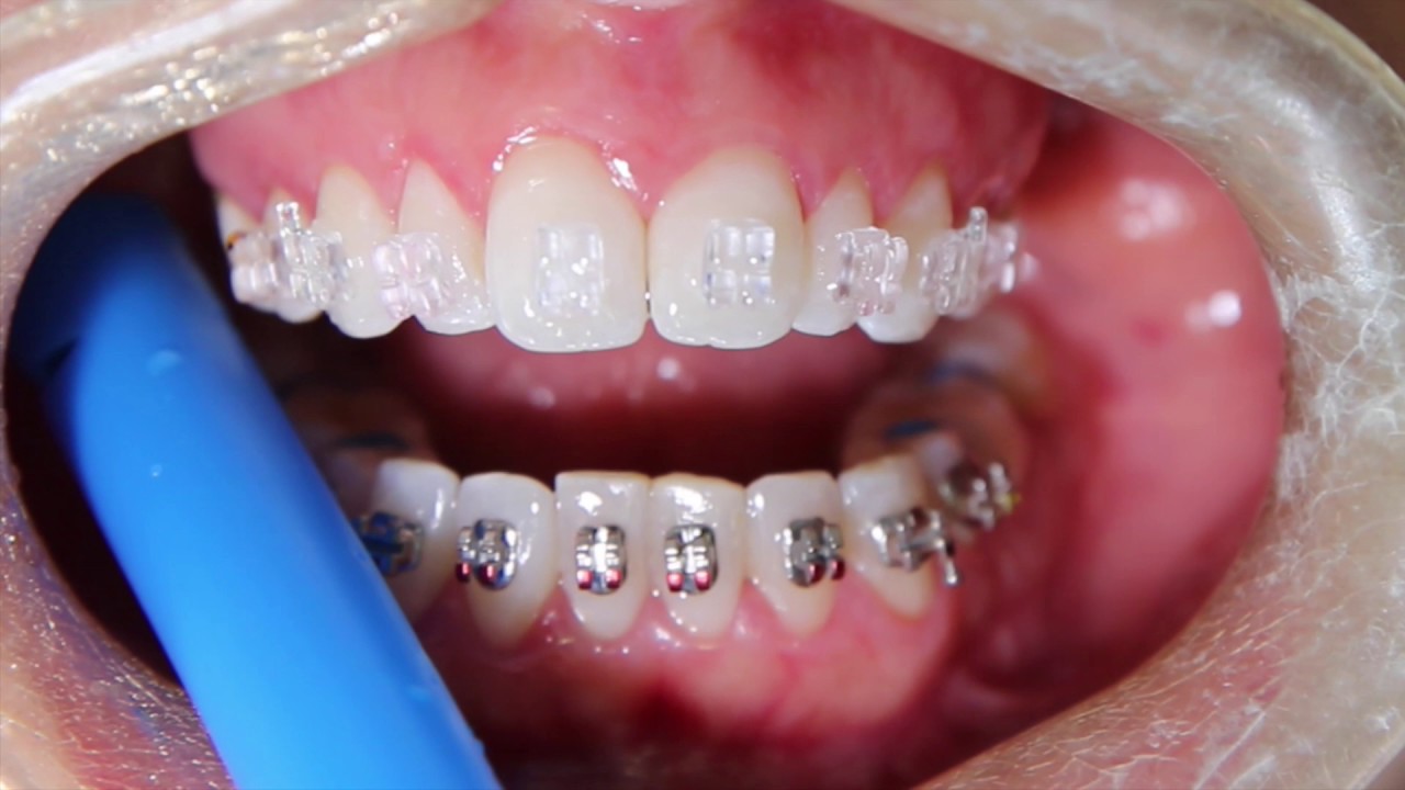 Clear Ceramic Braces YouTube