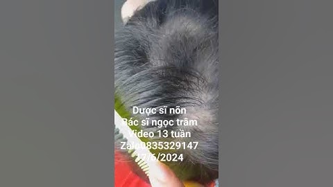 rụng tóc mảng. bé khang vĩ. video 13 tuần