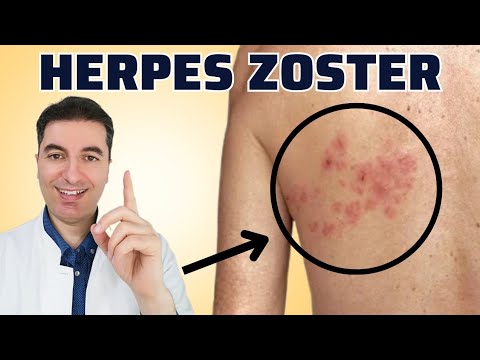 ቪዲዮ: Zoster vesicles ተላላፊ ናቸው?