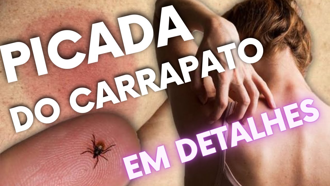Tipos De Picadas De Carrapatos Percevejos De Cama | Tipos E Ciclo De