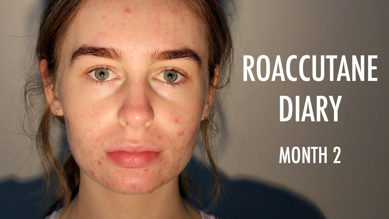 Roaccutane Diary: Month 2 | Katie Joslin
