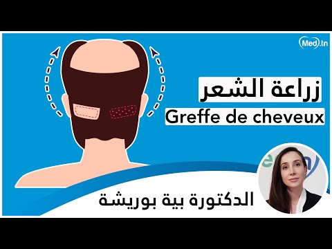 زراعة الشعر الدكتورة بية بوريشة