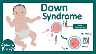 Down Syndrome | Genetics , diagnosis and pathology of Down syndrome | USMLE step 1