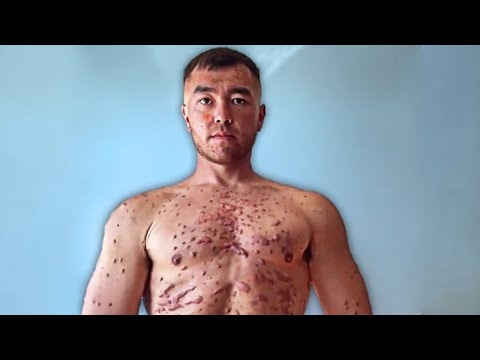 Steroid Abuser Left With Scars And Boils