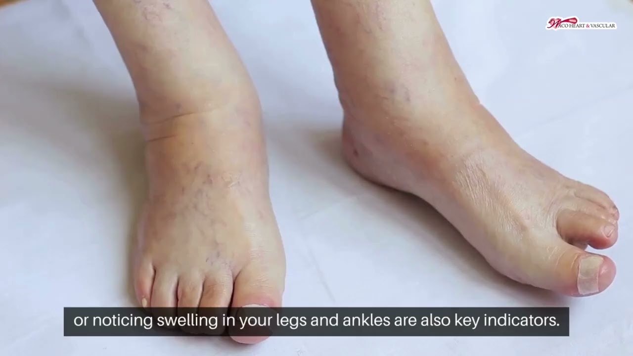 PAD Screening in Waco, TX | Why Early Detection Saves Lives