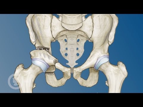 Hip Preservation Options for Young Adults